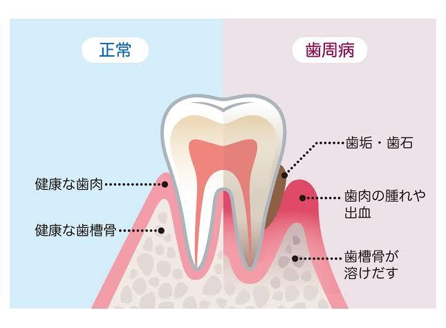 〜歯垢とは＊歯や歯肉に及ぼす影響＊〜